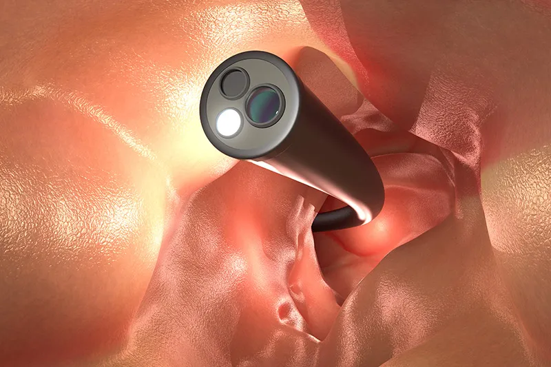 3D illustration of the concept of a colonoscopy.